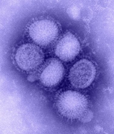 First H1N1 case detected in Moradabad, special ward reserved