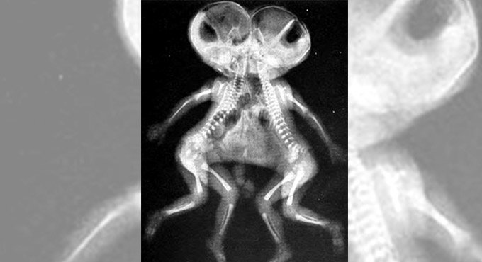 1st in King George’s Medical University: Siamese twins separated