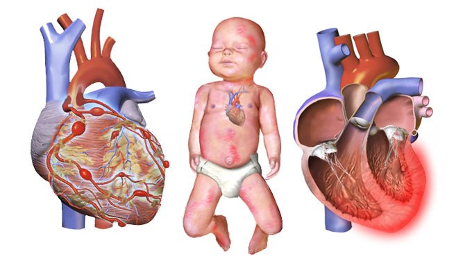 Kids with Kawasaki at higher risk of cardiac issues: Study