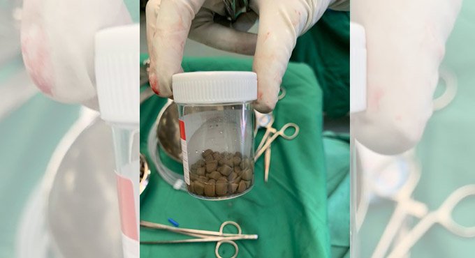 Whopping 55 stones removed from woman patient’s kidney in Hyderabad