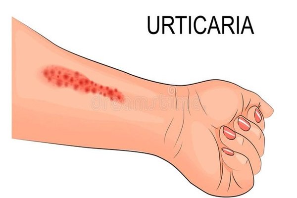 Understanding Urticaria