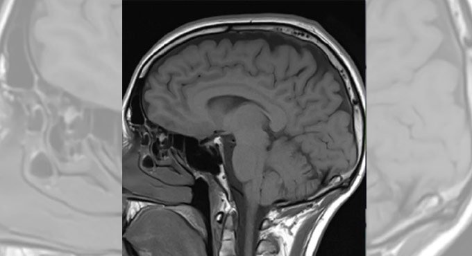 New drug-delivery system could treat brain disorders