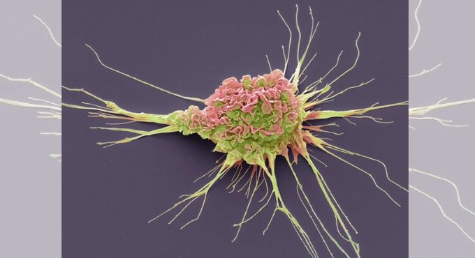 Novel tech may help cancer patients manage symptoms