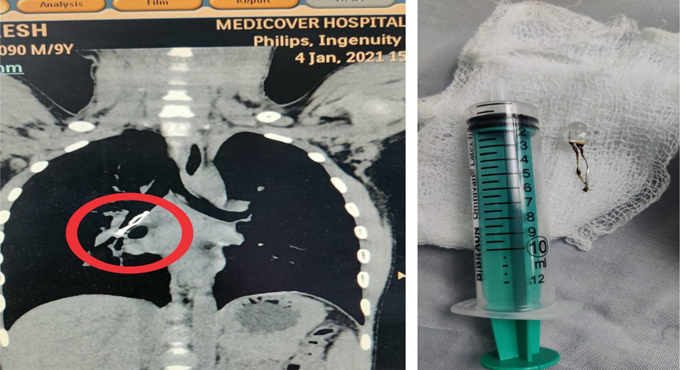 Hyderabad doctors remove toy bulb from 9-yr-old’s lungs