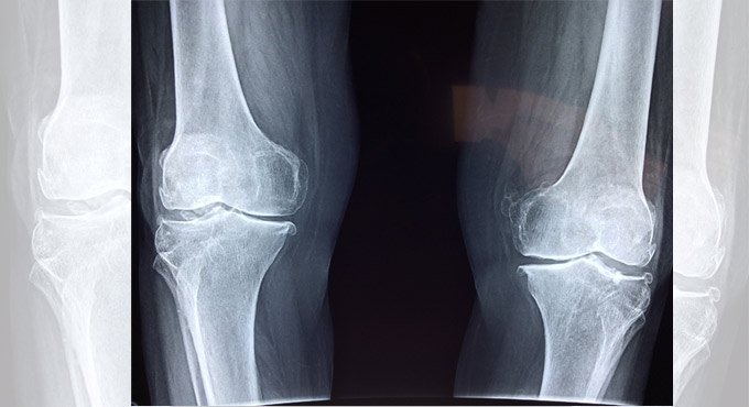 This alternative surgery may prevent total knee replacement