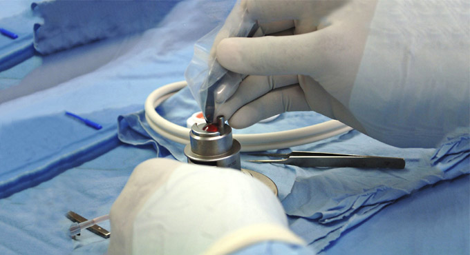 LVPEI Eye Bank distributed 40 per cent of corneas in India