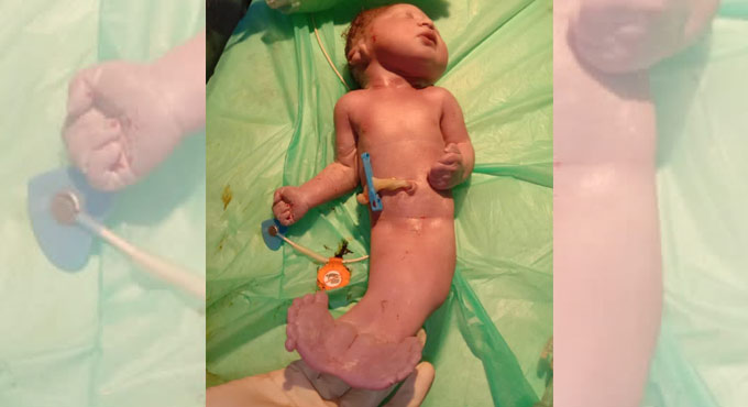 Newborn with rare Mermaid Syndrome passes away in Hyderabad
