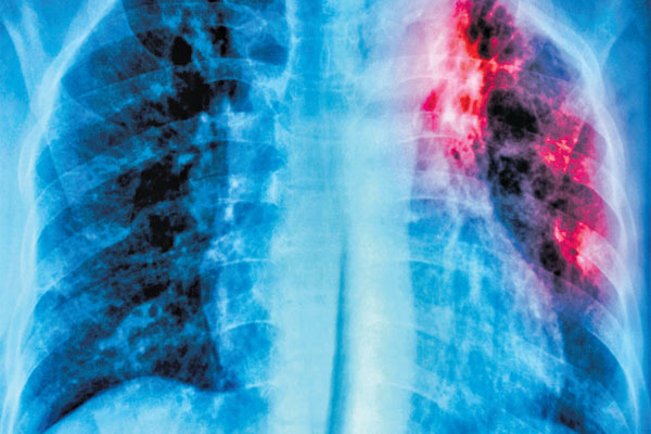 Tuberculosis: Deadly infectious but curable disease