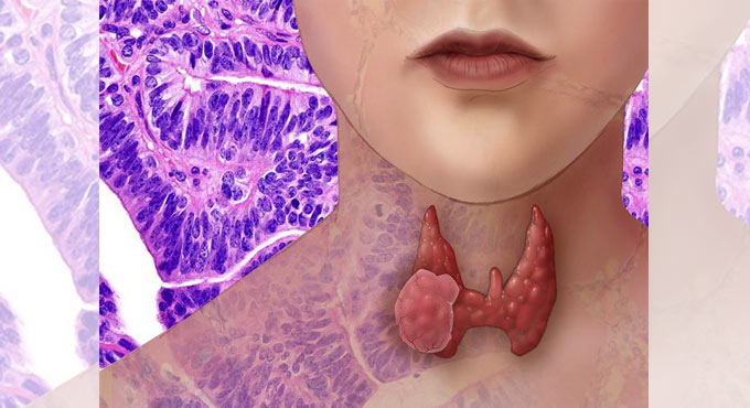 Study finds COVID-19 can cause atypical thyroid inflammation