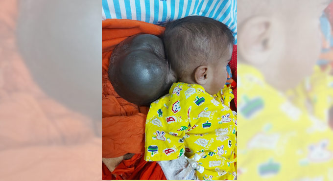 Hyderabad: Doctors remove head-sized lump near the brain of 6-month-old