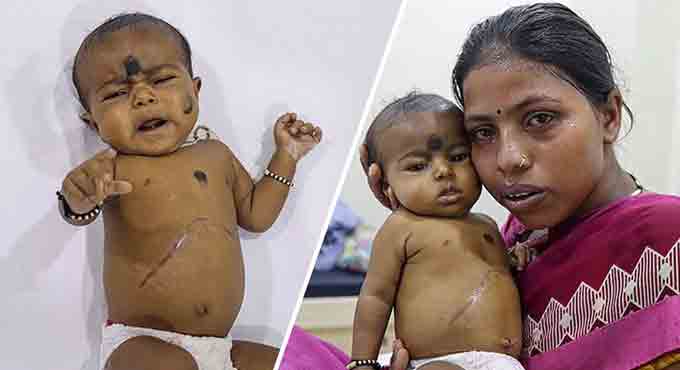 Daily wager needs Rs 20 lakh to save her baby’s life