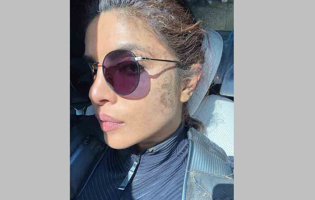 Priyanka Chopra shares selfie with fake and real wounds