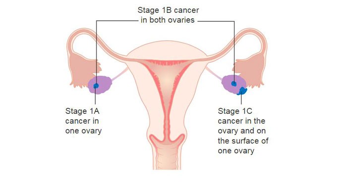Potential therapeutic target identified for ovarian cancer
