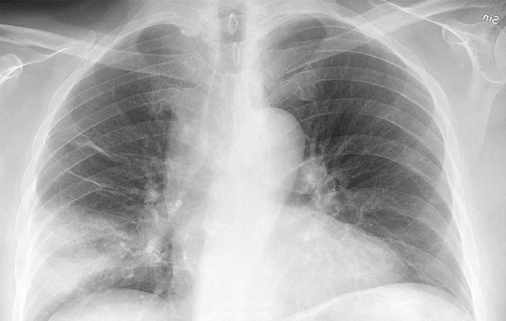 Study finds how lung disease develops long after virus has been cleared ...