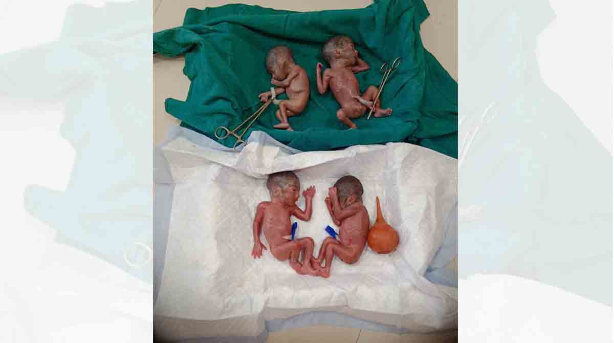 Woman delivers quadruplets, one dies in Sangareddy