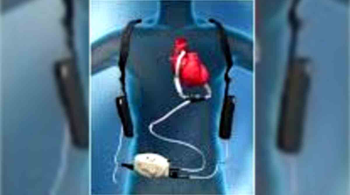 Kerala’s first artificial heart implantation done successfully on a 61-year-old woman