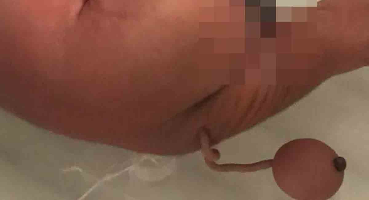 Baby born with a 12 cm-long ‘human tail’