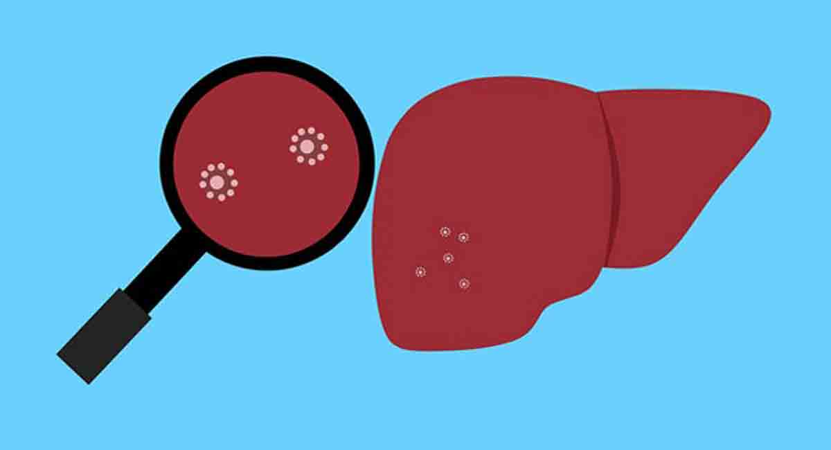 Researchers develop new stratification tool for liver cancer risk