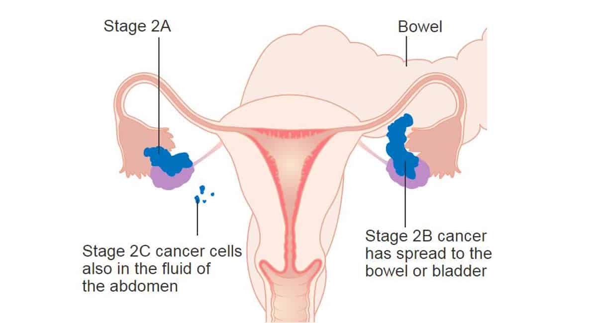 Research explains how ovarian cancer begins in high-risk women