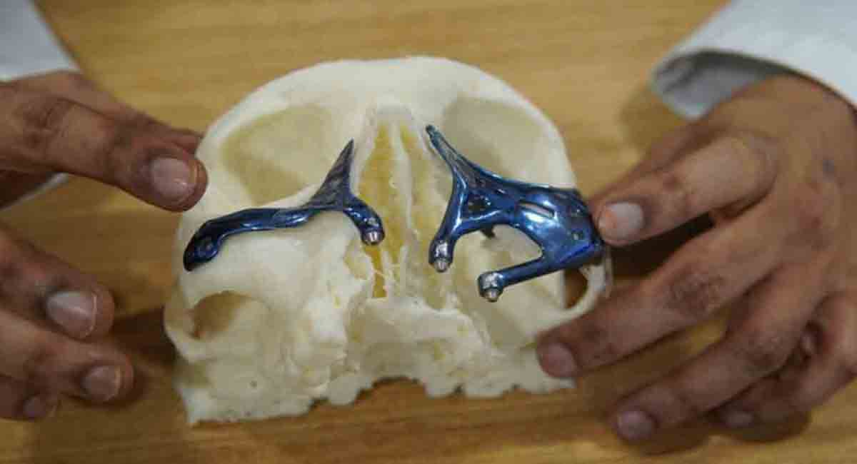 Hyderabad: Surgeons restore upper jaw of Mucormycosis survivor