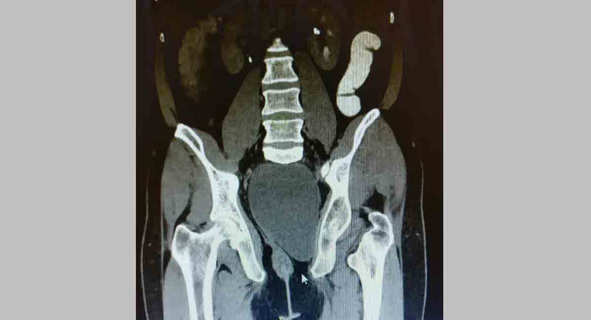 Hyderabad: Patient with congenital cyst treated at KIMS Kondapur