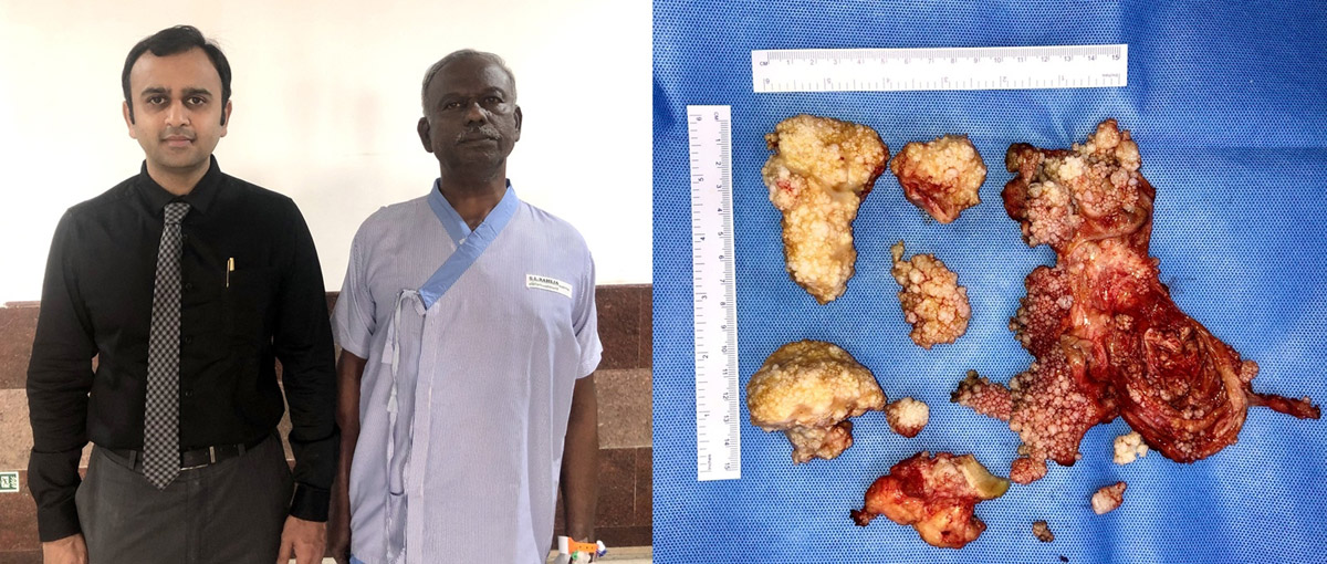 Docs remove cucumber-sized stones from man’s knee!