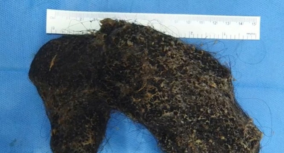 Doctors at Hyderabad hospital remove hairball from Omani girl’s stomach