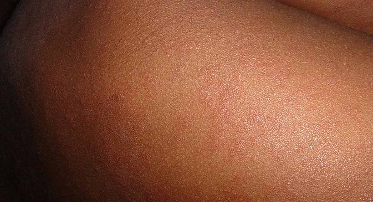 Unicef warns against global measles outbreaks