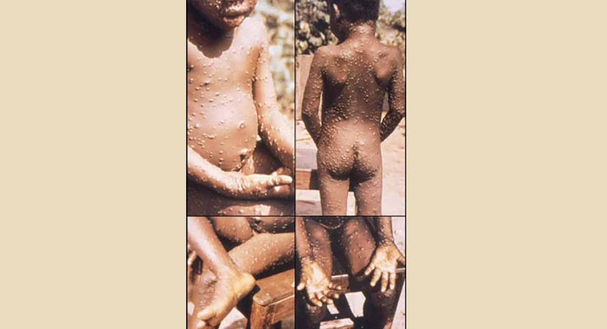 Monkeypox primarily spread via sexual contact, but containable: WHO