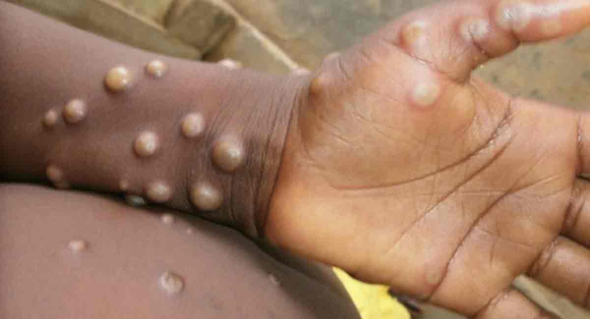 Monkeypox: Trivitron healthcare develops real-time PCR based kit in India