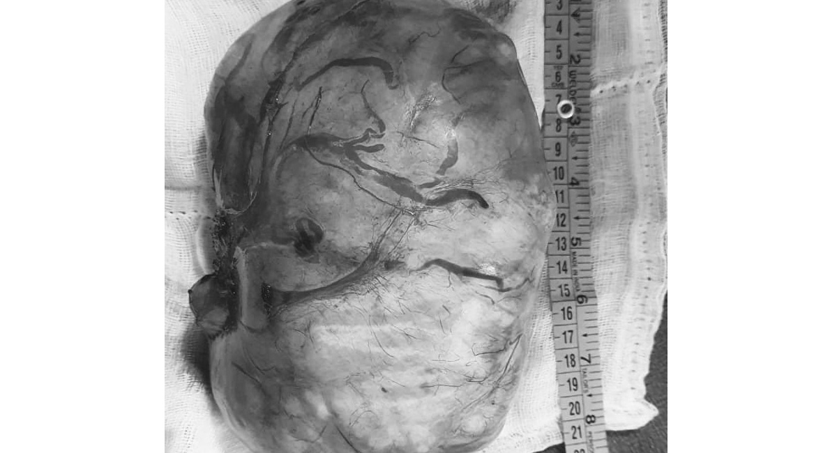 Doctors at SLG Hospitals remove 3 kg giant fibroid from woman’s uterus