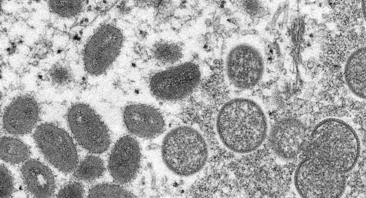 Explainer: What is monkeypox and where is it spreading?