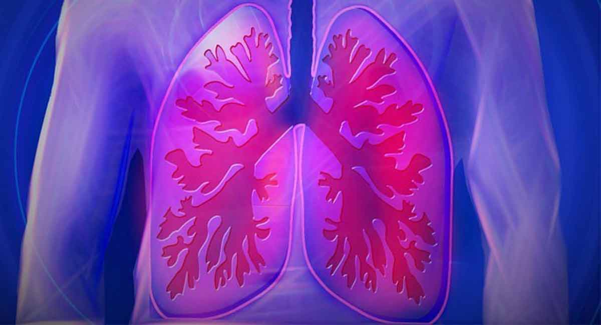 Study links area-level income and education with lung cancer diagnosis