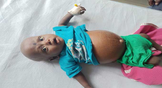 Osmania, Niloufer hospitals perform liver transplant on infant with rare syndrome