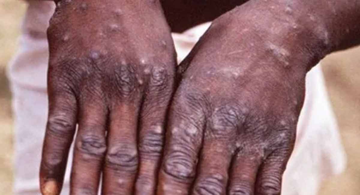 Afghanistan to receive monkeypox test kits from WHO
