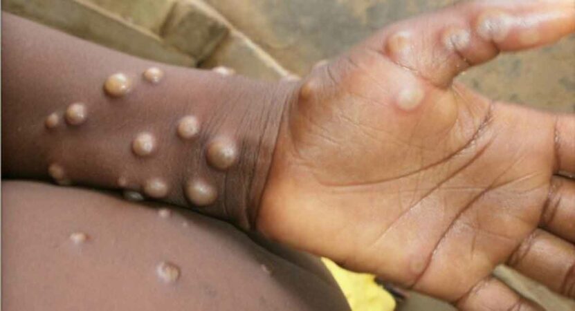 Canada confirms 58 cases of monkeypox