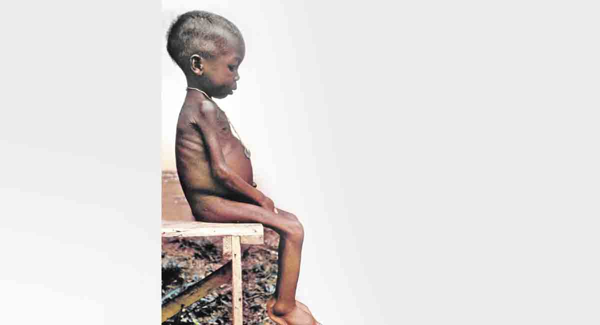 Diseases associated with malnutrition