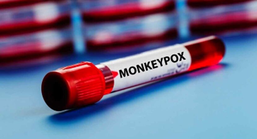 One more suspected case of monkeypox in Telangana
