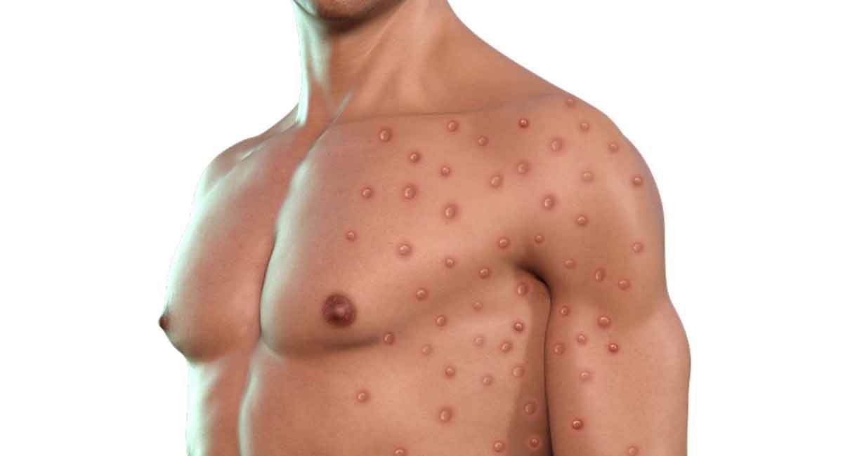 India’s policy on fighting monkeypox is good but can be better: Dr Sunil Raina, World Health Network