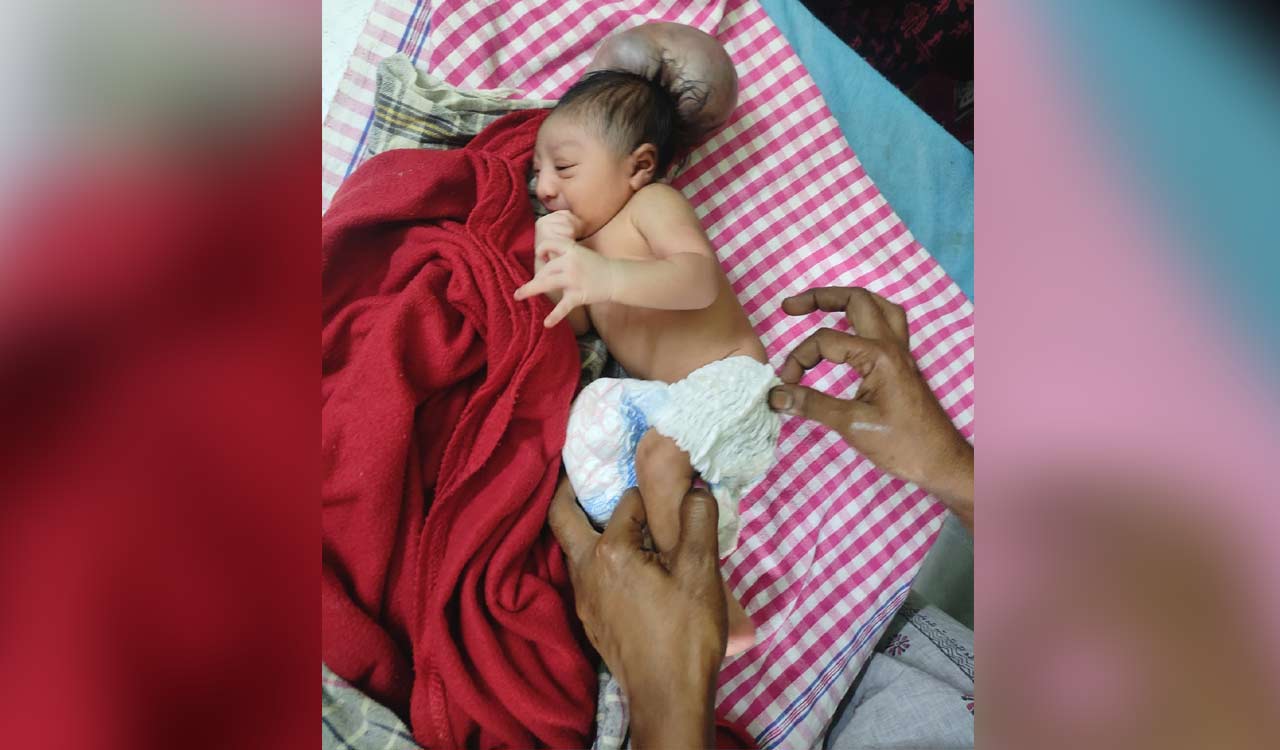Telangana: Newborn baby with congenital anomaly abandoned