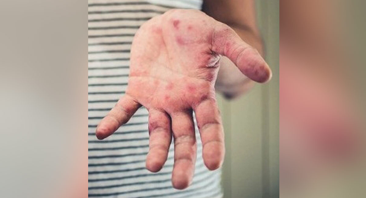 Uttar Pradesh government issues advisory on tomato flu