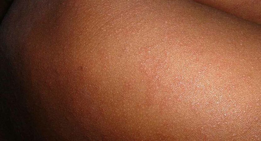 Measles outbreak in Zimbabwe kills 157 unvaccinated children