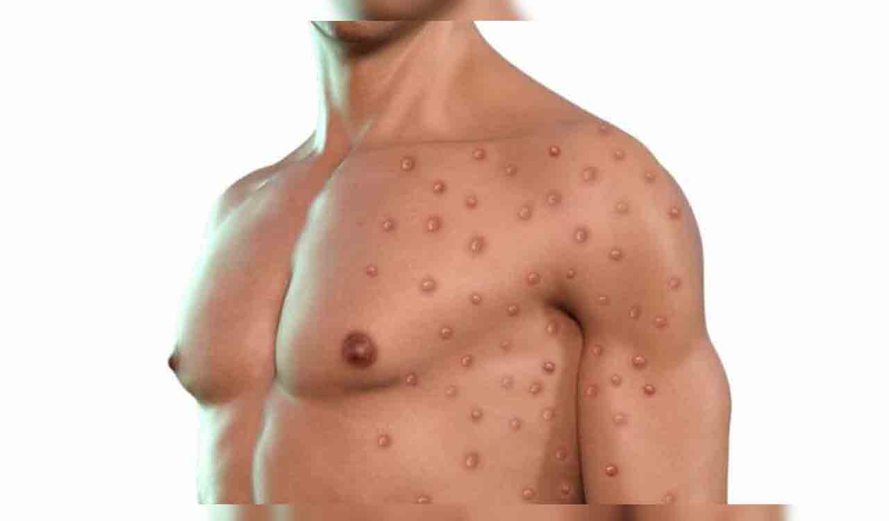 US reports over 17,000 monkeypox cases