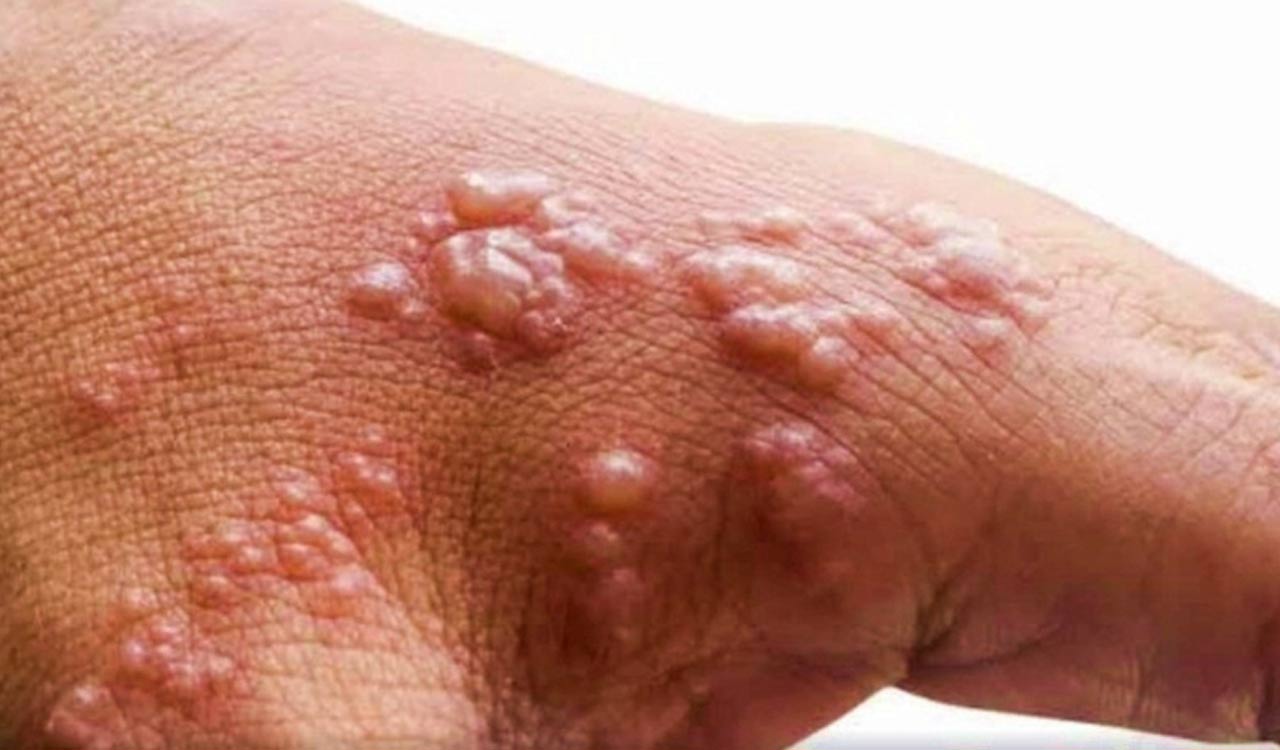 ICMR performs genome characterisation of monkeypox cases, identifies 3 sub-clusters among A.2 lineage in India