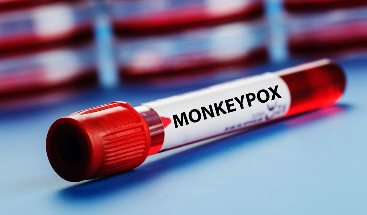 US likely records its 1st monkeypox death
