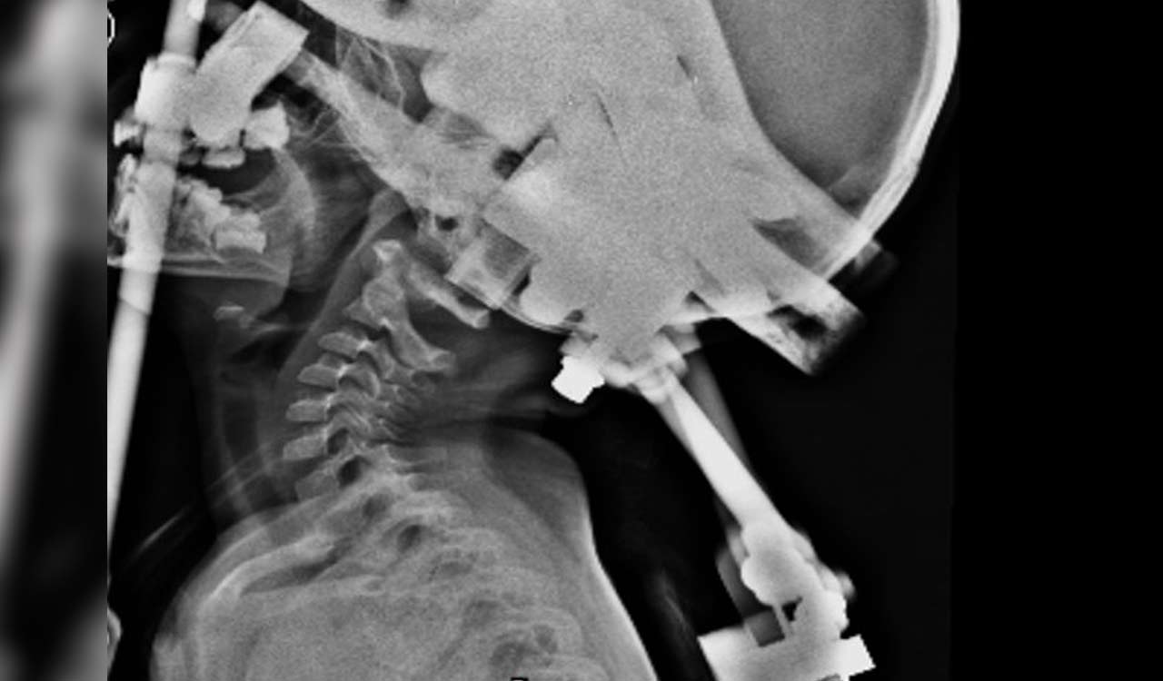 Surgeons conduct complex neck surgery on a 3-year-old girl in Hyderabad