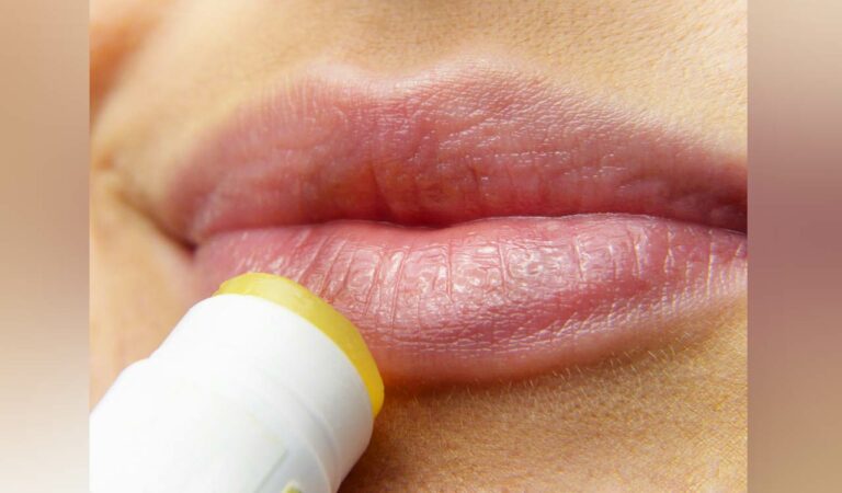 chapped lips