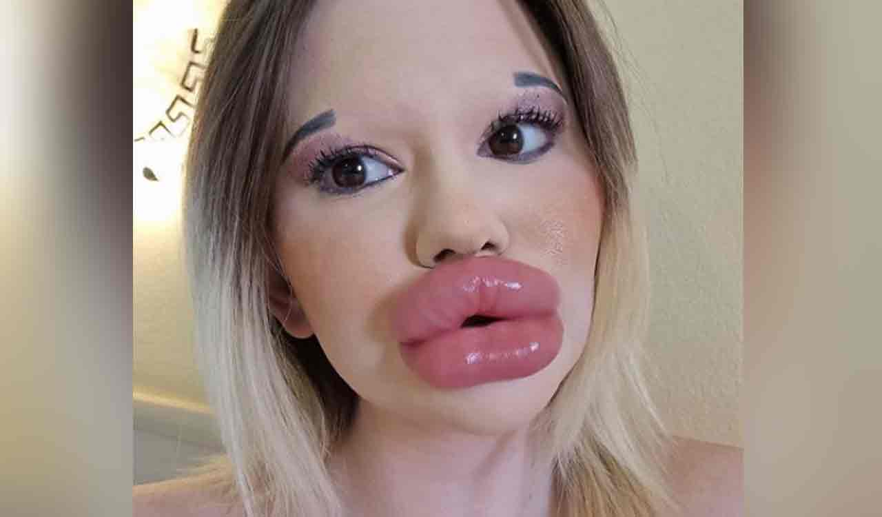 Woman spent over Rs 7.5 lakhs for world’s biggest lips 