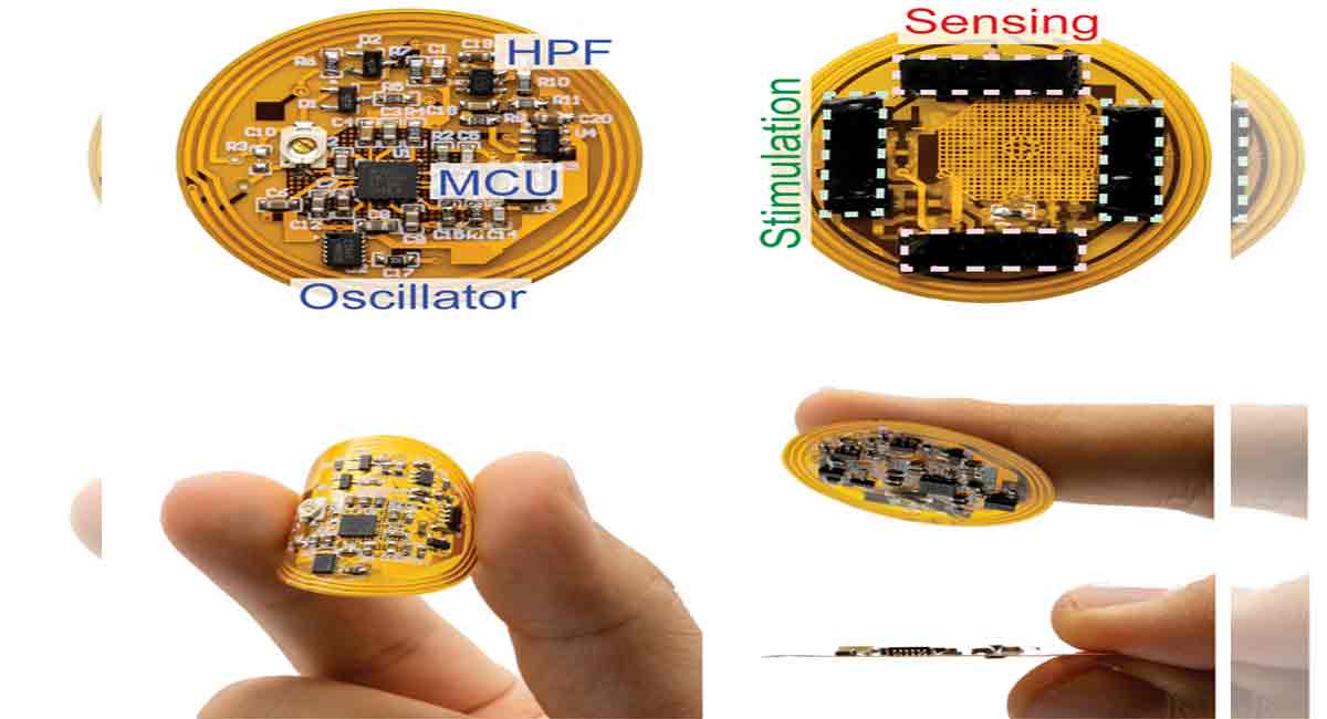 Smart bandage to speed healing time of chronic wounds by 25 per cent 