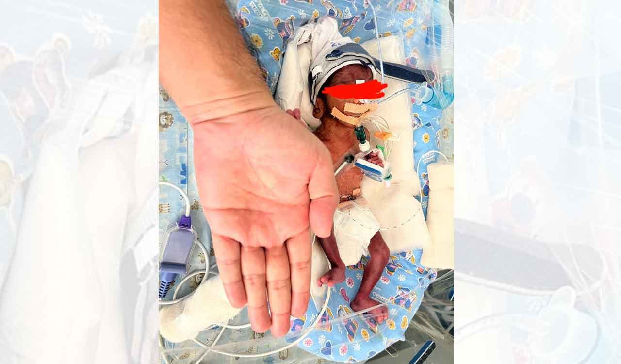 Renova Hospitals paediatric team saves preterm baby weighing just 720 grams